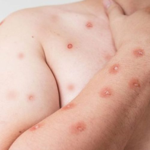 Sintomas de mpox. (Divulgação, Ministério da Saúde)